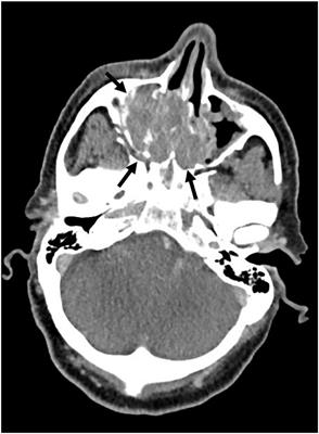 Case Report: Two Cases of Salivary Duct Carcinoma in Workers With a History of Chromate Exposure